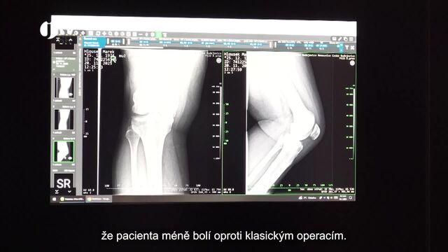 2. díl - Artroskopie